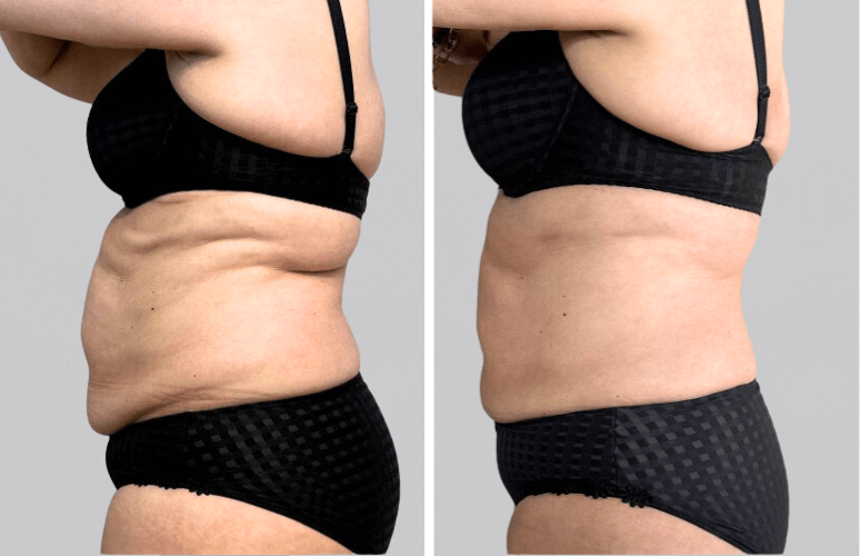 CoolSculpting